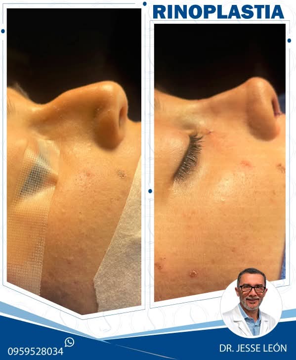 Rinoplastia antes y después